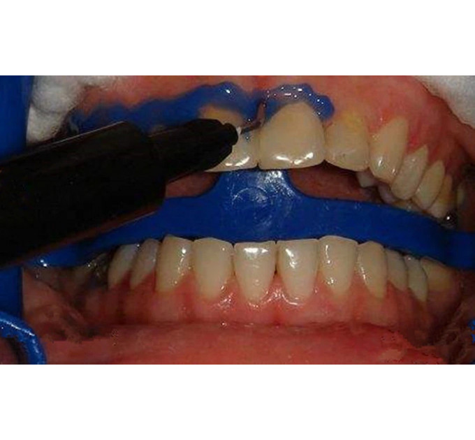 Стоматологічний захисний гель для ясен EZGO Gingival Barrier 3 мл набір 10 шприців