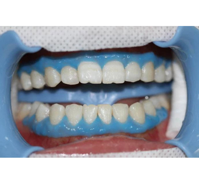 Стоматологічний захисний гель для ясен EZGO Gingival Barrier 3 мл набір 10 шприців