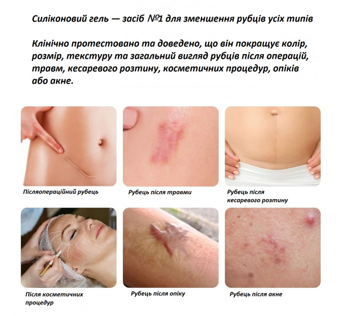 Набір засобів для лікування рубців MURASAKI BEAUTY 100% Silicone Gel 30 г і SPF 30 Cream 30 г