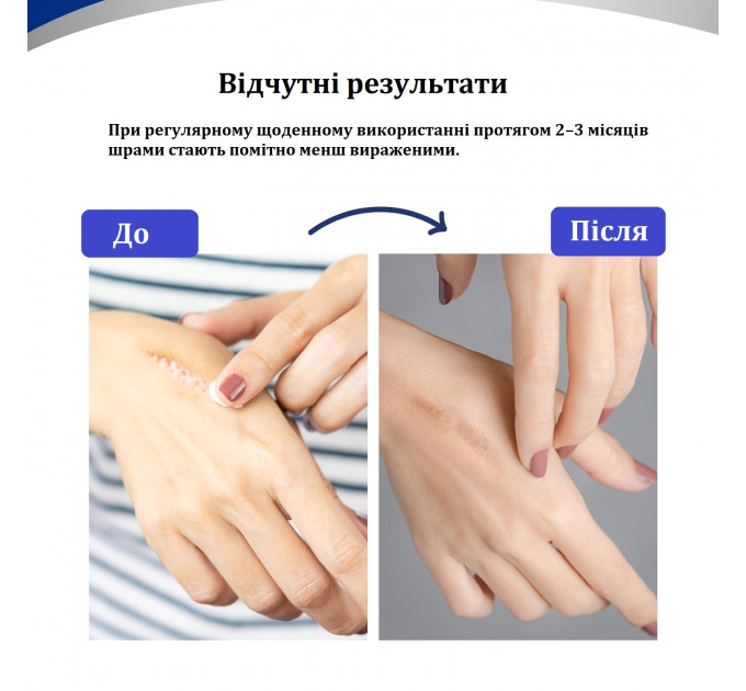 Силіконовий пластир від шрамів Murasaki Beauty 4×150 см