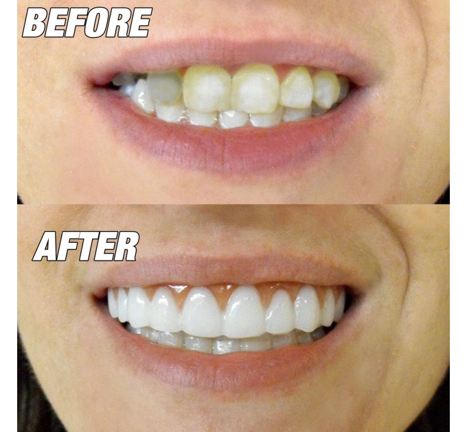 Накладні вініри Instant Smile Comfort Fit Flexible Lower для нижніх зубів