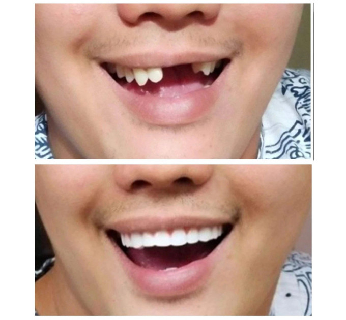 Накладні вініри Instant Smile Comfort Fit Flexible Lower для нижніх зубів