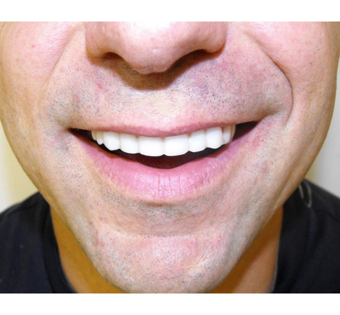 Накладні вініри Instant Smile Comfort Fit Flexible Lower для нижніх зубів