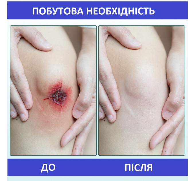 Гідроколоїдний пластир від шрамів і ран в рулоні ELAIMEI 360 х 5 см