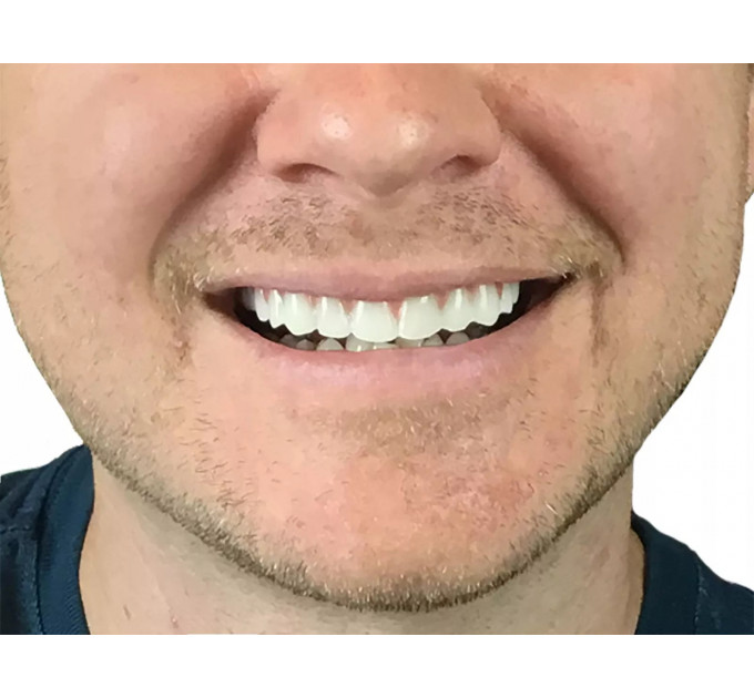 Накладні вініри Instant Smile Natural Shade для верхніх зубів