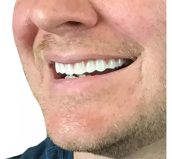 Накладні вініри Instant Smile Natural Shade для верхніх зубів