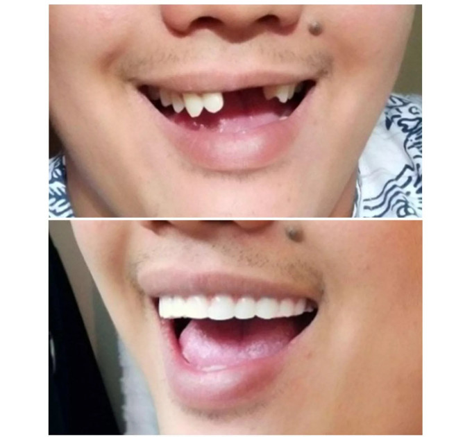 Накладні вініри Instant Smile Natural Shade для верхніх зубів