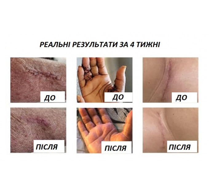 Силіконовий гель від шрамів і рубців з SPF 30 Murasaki Beauty 30 г