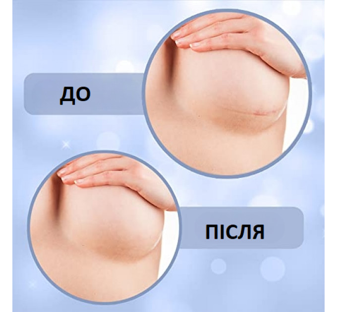 Силіконові пластирі проти шрамів Miztag Home & Health для реабілітації після пластики грудей 4 пари