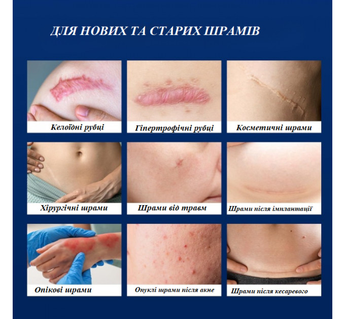 Силіконові пластирі від шрамів і рубців Murasaki Beauty 4 шт розмір 15 x 4 см бежеві