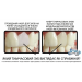 Набір для тимчасової заміни зуба Instant Smile 30 Assorted Temporary Tooth Kit Deluxe (30 шт 3 відтінки)