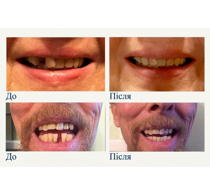Набір для тимчасової заміни зуба Instant Smile 30 Assorted Temporary Tooth Kit Deluxe (30 шт 3 відтінки)