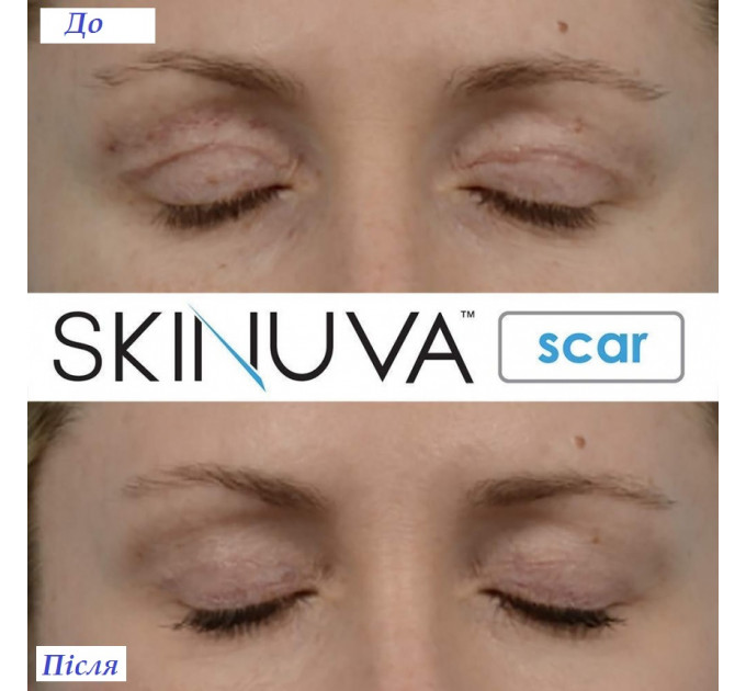 Крем від шрамів з факторами росту Skinuva Next Generation Scar Cream