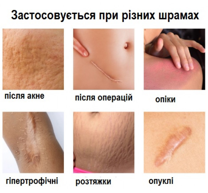 Пластир від шрамів та рубців силіконовий South Moon (150х4 см)