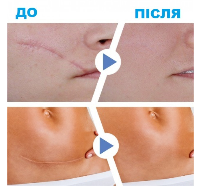 Пластир від шрамів та рубців силіконовий South Moon (150х4 см)