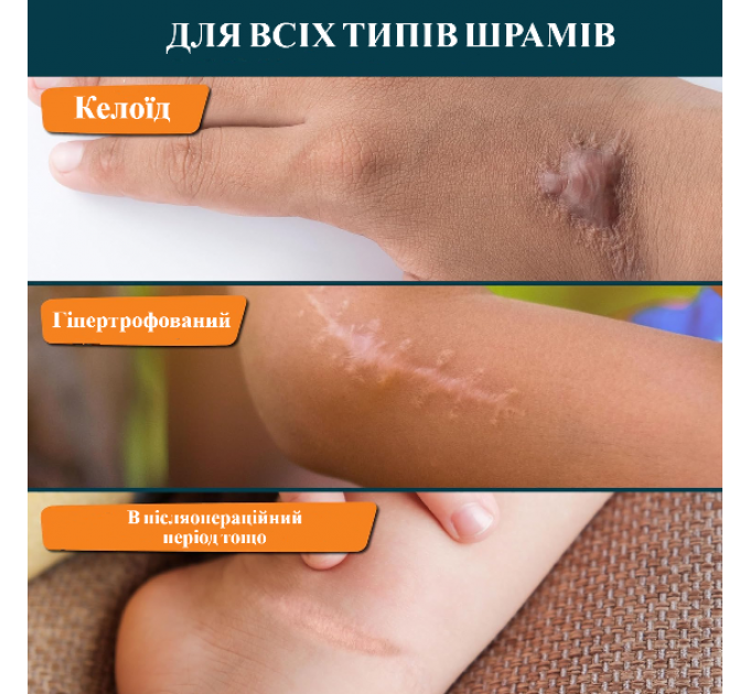 Дитячий силіконовий пластир для загоєння шрамів і рубців Nuvadermis 4х300см